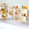 VERTEBRA12 (12396) Medical Science Life-size Lumbar Vertebrae Models in 3 Stages of Degeneration